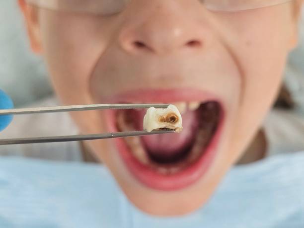 Best Emergency Dental Care for Abscessed Tooth in Joshua, TX